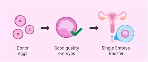 Embryo Transfer: Procedure and Types