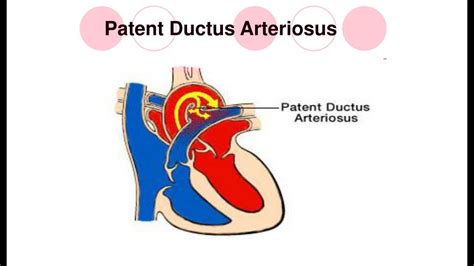 PDA | Congenital heart defect (4) | with mnemonics !! - YouTube