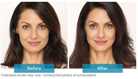 Facial Contouring – COSMEDICS | MEDICAL AND COSMETIC CLINIC