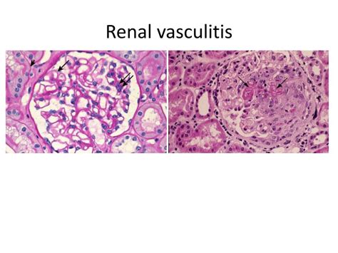 PPT - Renal Manifestations of Systemic Disease PowerPoint Presentation - ID:1487130