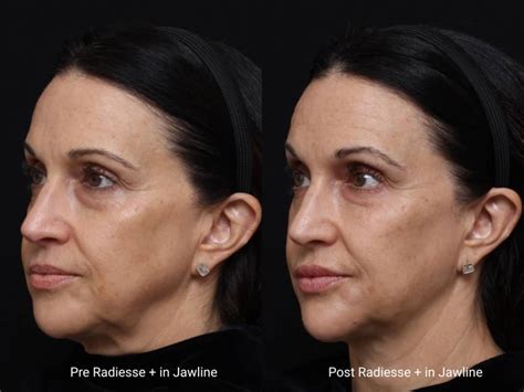 Jawline Contouring and Slimming: Jawline Filler or Jawline Botox? - Brian S. Biesman M.D.