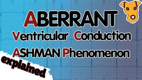 ABERRANT VENTRICULAR CONDUCTION. Ashman Phenomenon. Explained. - YouTube