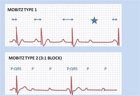 Study Medical Photos: ECG Findings In Different Types Of Heart Block.