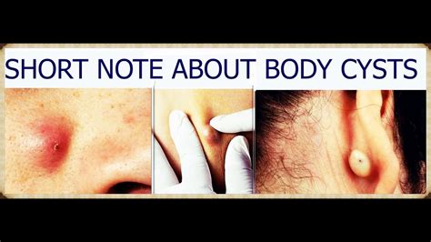 All you need to know about cysts that occur in your body - YouTube