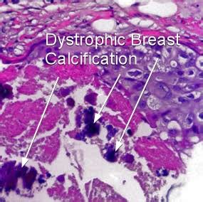 Dystrophic Calcification of the Breast - Moose and Doc