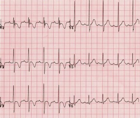 R wave • LITFL • ECG Library Basics