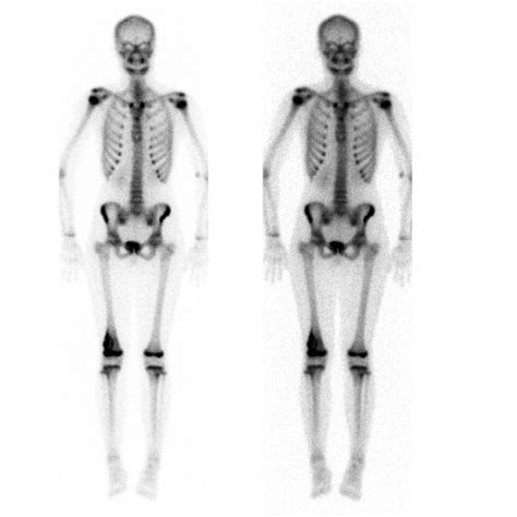 Osteosarcoma x ray - wikidoc