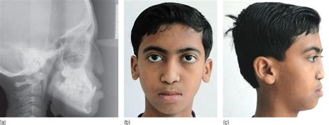 3 Orthodontic Diagnosis and Treatment Planning: Collaborating with Medical and Other Dental ...