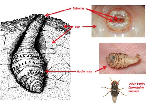 Bot Fly Larvae Human Skin