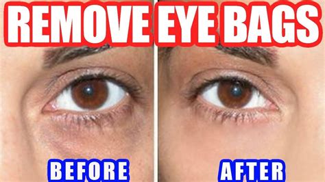 How to Get Rid of Bags Under Eyes – Best Way to Remove Under Eye Bags ...