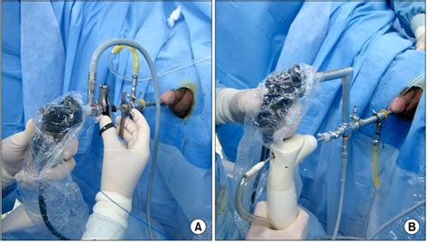 Green Light Laser Prostatectomy Vs Holep | Americanwarmoms.org