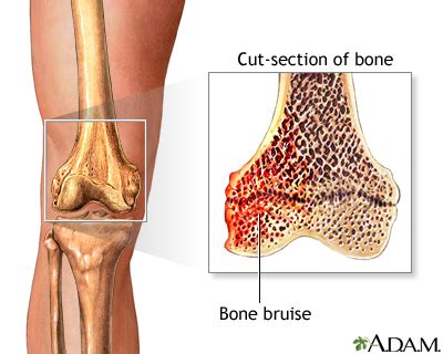 Bone Bruise: Types, Causes and Treatments | MD-Health.com