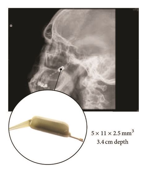 (a) The neurostimulator implant inside the head to relieve headache... | Download Scientific Diagram