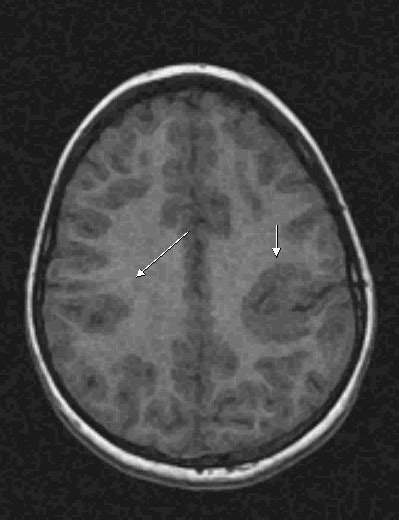 Cortical Dysplasia-MRI - Sumer's Radiology Blog