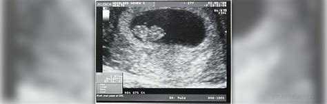 Ultrasound imaging for endometrial hyperplasia | Women's Health articles | Family Health center ...