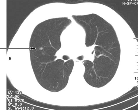 Screening for lung cancer using low dose CT scanning | Thorax