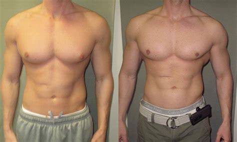 Gynecomastia Causes and Treatment For Bodybuilder | Entrepreneurs Break