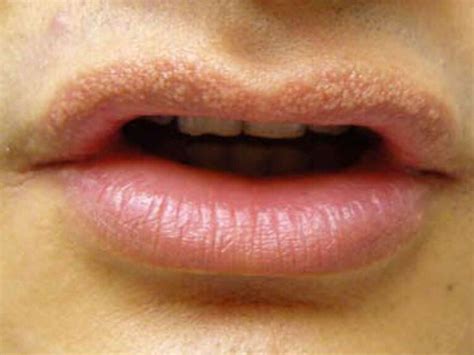 White Spots on Lips Causes, Pictures, Small, on Lower, Upper, Inside Lip - American Celiac