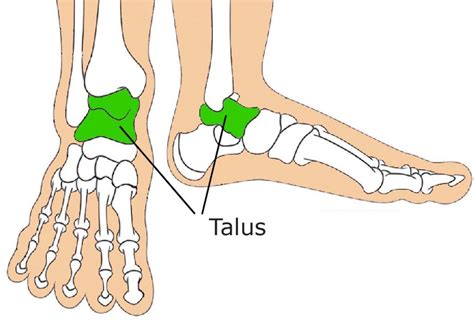 Congenital Vertical Talus - Prof. Nicola Portinaro - Orthopedic Suregon