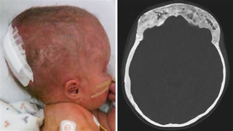 This Baby was Born Without a Brain, then Years Later the Doctors ...