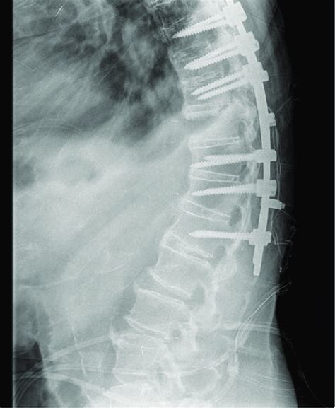 Postoperative profile radiogram of the thoracolumbar junction. This... | Download Scientific Diagram