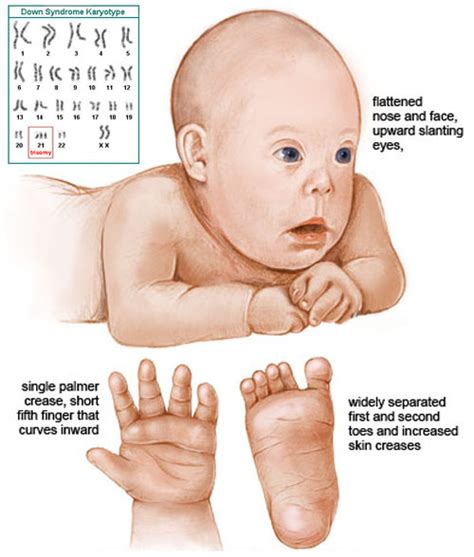 How to diagnose Down syndrome from the hands only? | Palm Reading Perspectives