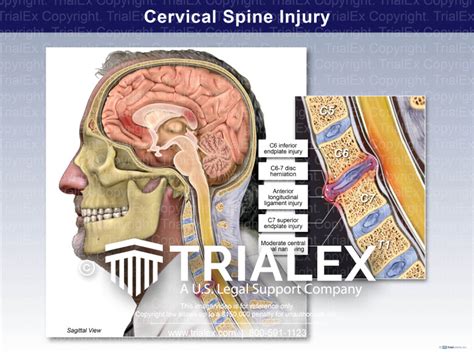 Cervical Spine Injury - TrialExhibits Inc.