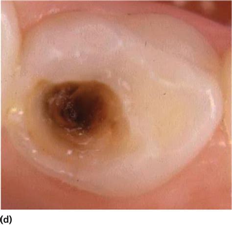 12: Diagnosis and Management of Dental Caries | Pocket Dentistry