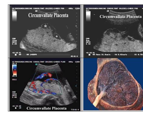 Circumvallate placenta | Placenta, Supportive, Remember