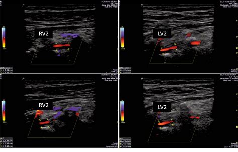 Figure 1 from Bilateral vertebral artery occlusion without stroke secondary to giant cell ...