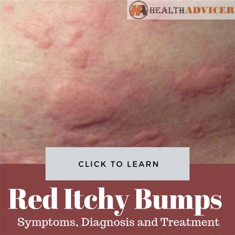 Red Itchy Bumps On Skin Causes Treatment Pictures Minhhai2d Help ...