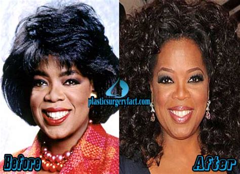 Oprah Winfrey Plastic Surgery Before and After Photos