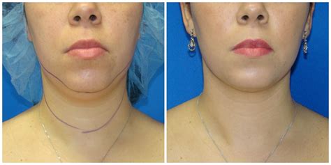 Patient #251 Female Liposuction Before and After Photos Katy - Plastic ...