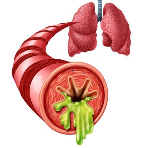 Acute Bronchitis: 7 Home Remedies for Coping with a Chest Cold | Asthma ...