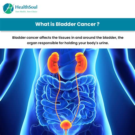 Bladder Cancer: Symptoms and Treatment – Healthsoul