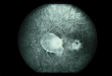 Optic Disc Pit and CSR - Retina Image Bank