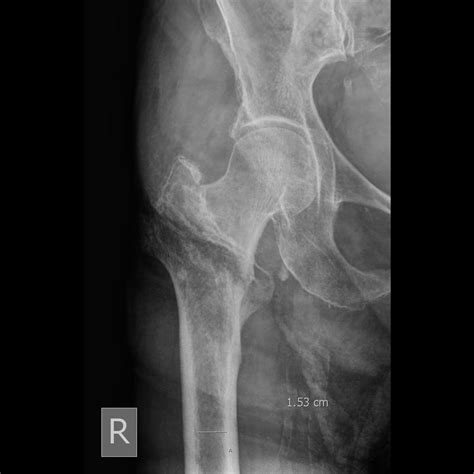 Femoral neck fracture x ray - Trosdeath