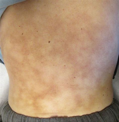 Erythema ab igne | Cleveland Clinic Journal of Medicine