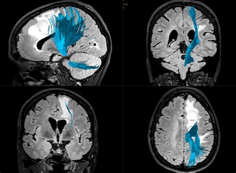 MRI Tractography - Brain Tumor