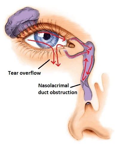 Baby Talk: Battling Infant Eye Infections and Blocked Tear Ducts with ...