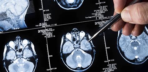 Omniprex News - Nuevo método menos invasivo para diagnosticar el tumor cerebral más agresivo