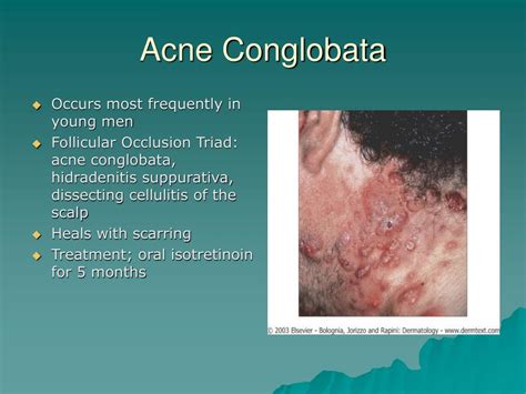 PPT - Acne PowerPoint Presentation, free download - ID:148058