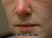 Nasal Cellulitis | eCellulitis