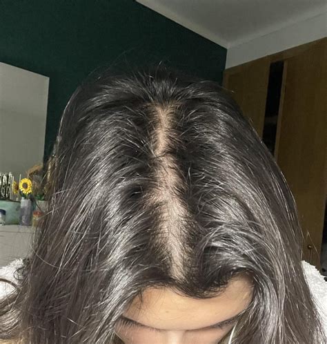 Nioxin before/after : r/FemaleHairLoss