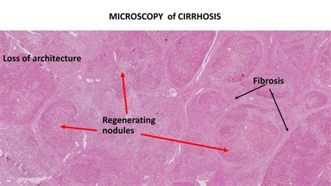 Liver Cirrhosis Histology