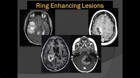 Brain Scans: Lord of the Ring Enhancing Lesions 101 - YouTube