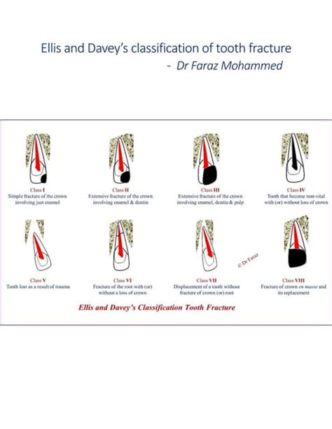 Ellis and davey’s classification of tooth fracture | PDF