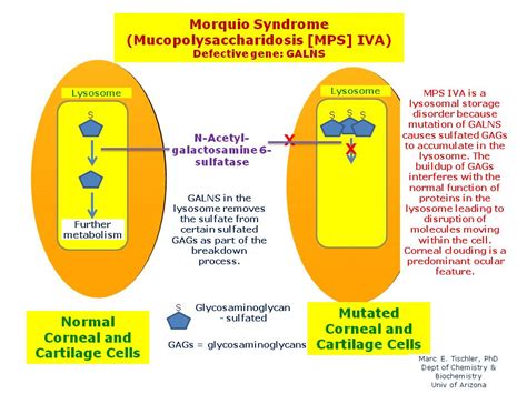 Morquio Syndrome (MPS IVA) | Hereditary Ocular Diseases