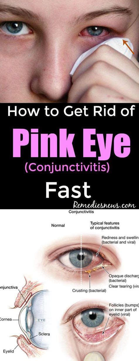 11 Best Pink eye home remedies images | Pink eyes, Pink eye home ...