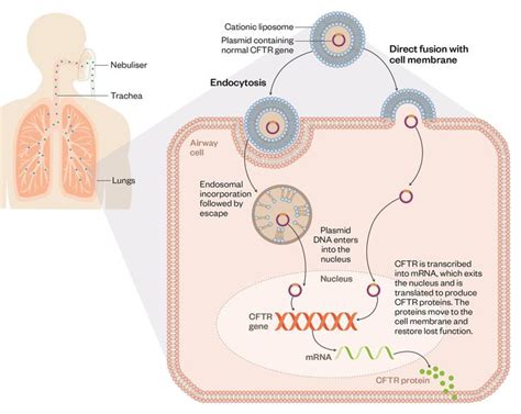 Developing gene therapy to treat cystic fibrosis: challenges and successes | Gene therapy ...